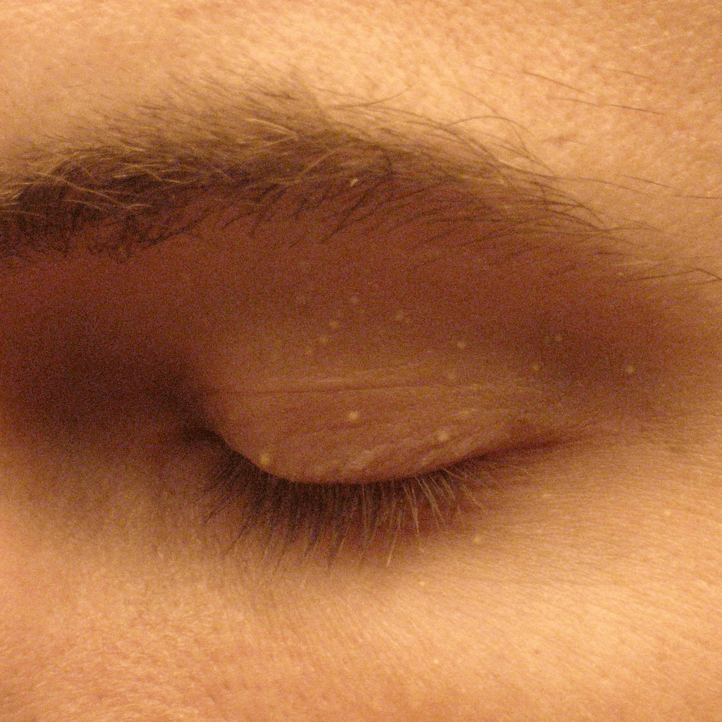 1024px-Milia_big Milia in adults