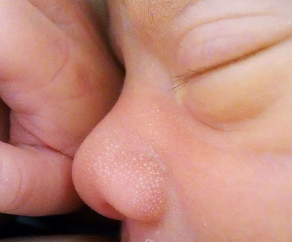 Newborn_Milia_(Milk_Spots)